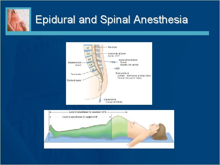 Epidural and Spinal Anesthesia 