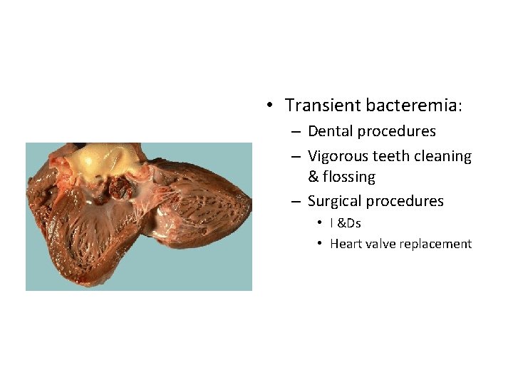  • Transient bacteremia: – Dental procedures – Vigorous teeth cleaning & flossing –