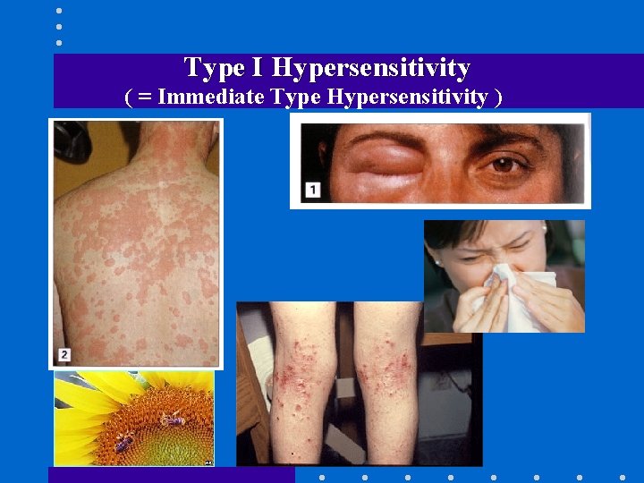 Type I Hypersensitivity ( = Immediate Type Hypersensitivity ) 