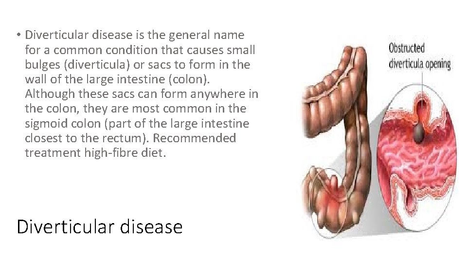  • Diverticular disease is the general name for a common condition that causes