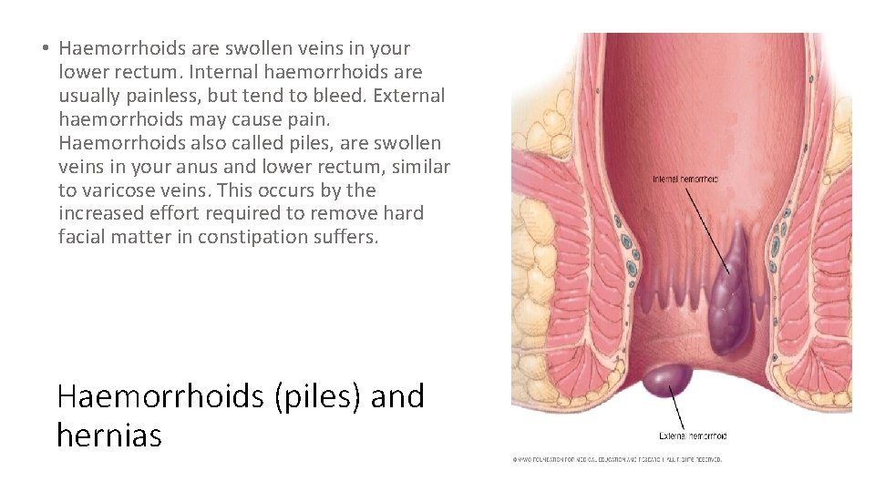  • Haemorrhoids are swollen veins in your lower rectum. Internal haemorrhoids are usually