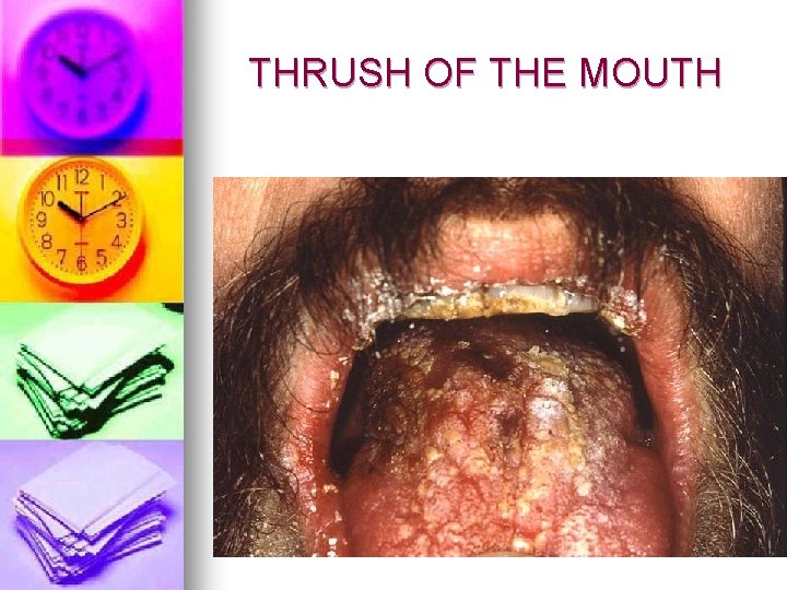 THRUSH OF THE MOUTH 