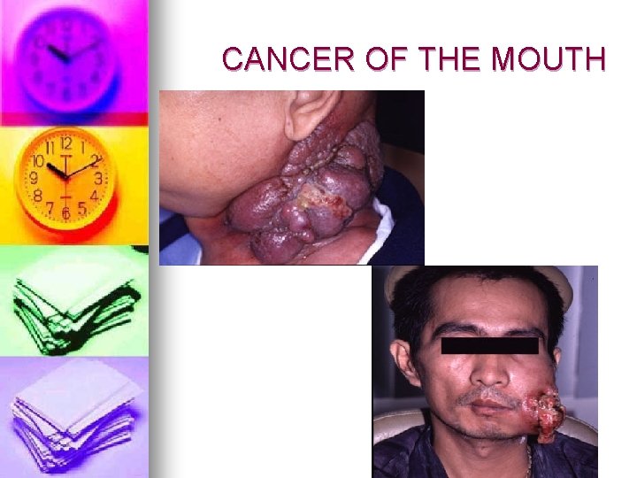 CANCER OF THE MOUTH 