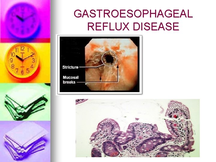 GASTROESOPHAGEAL REFLUX DISEASE 
