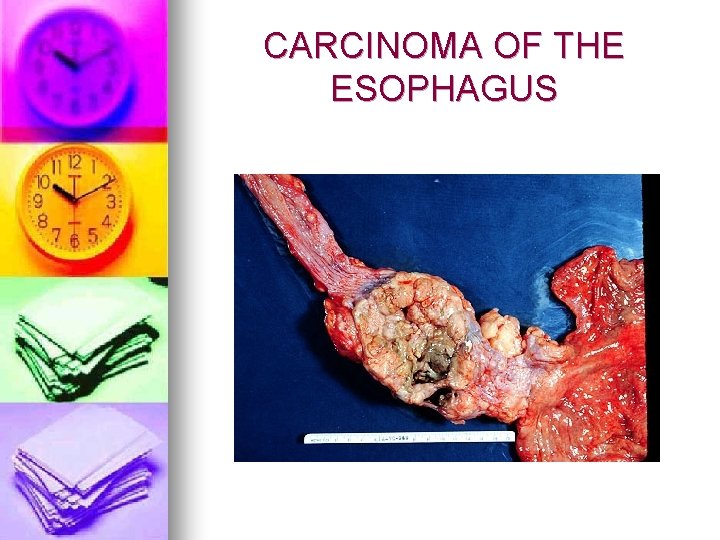 CARCINOMA OF THE ESOPHAGUS 