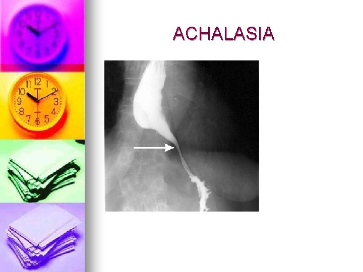 ACHALASIA 