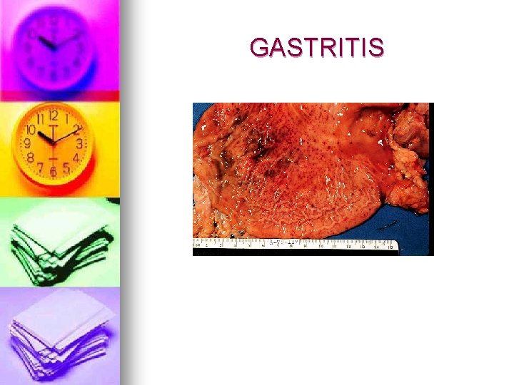 GASTRITIS 