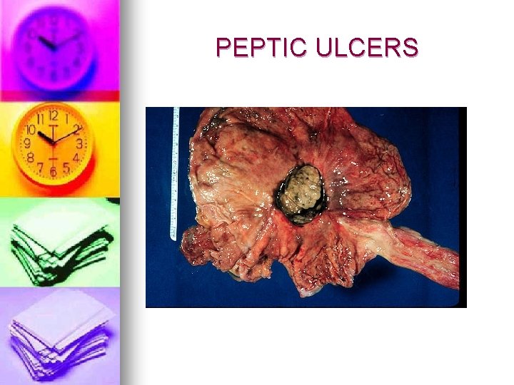 PEPTIC ULCERS 