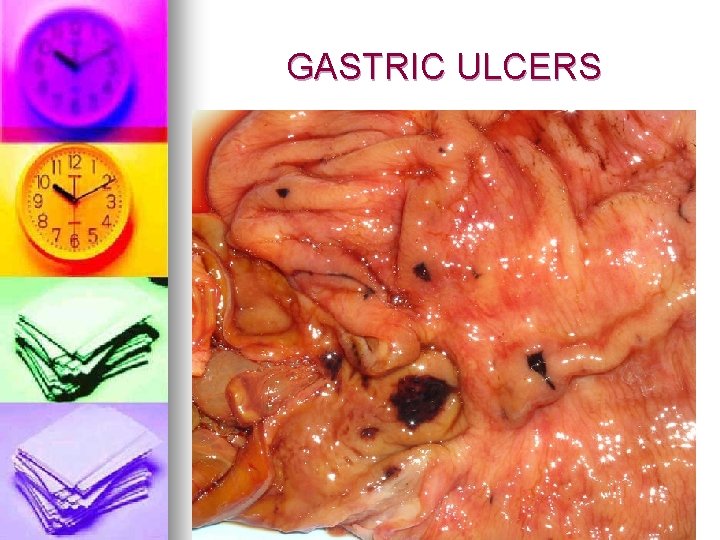 GASTRIC ULCERS 