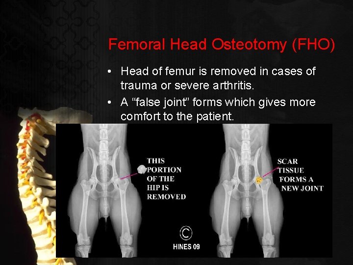 Femoral Head Osteotomy (FHO) • Head of femur is removed in cases of trauma