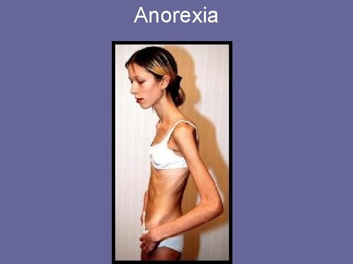 Anorexia 