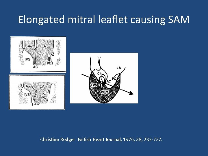 Elongated mitral leaflet causing SAM Christine Rodger British Heart Journal, 1976, 38, 732 -737.
