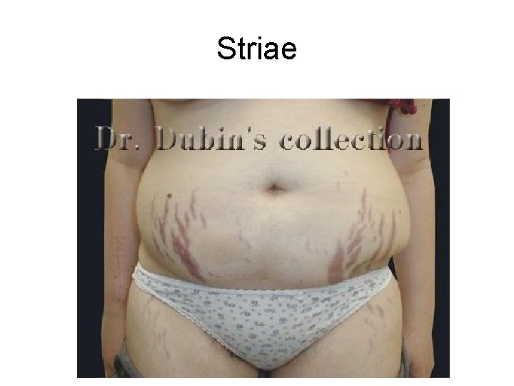 Striae 