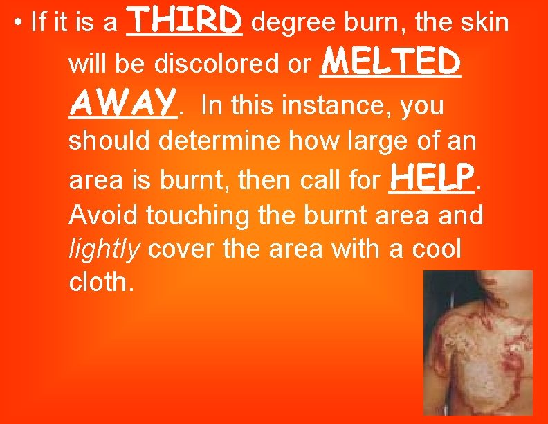  • If it is a THIRD degree burn, the skin will be discolored