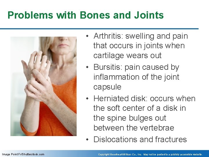 Problems with Bones and Joints • Arthritis: swelling and pain that occurs in joints