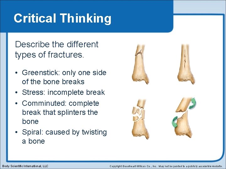 Critical Thinking Describe the different types of fractures. • Greenstick: only one side of