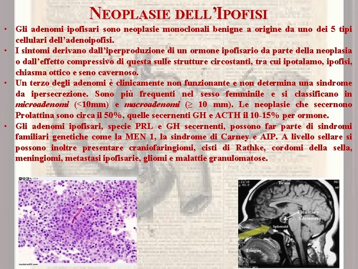 NEOPLASIE DELL’IPOFISI • Gli adenomi ipofisari sono neoplasie monoclonali benigne a origine da uno