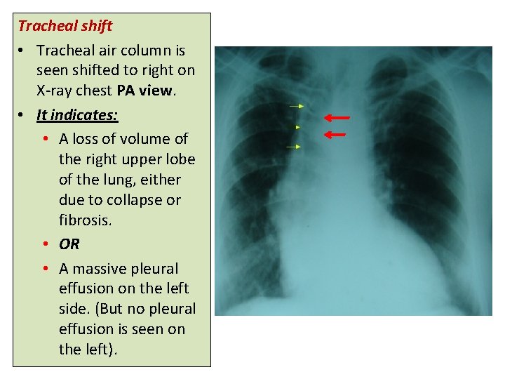 Tracheal shift • Tracheal air column is seen shifted to right on X-ray chest
