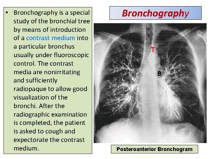  • Bronchography is a special study of the bronchial tree by means of