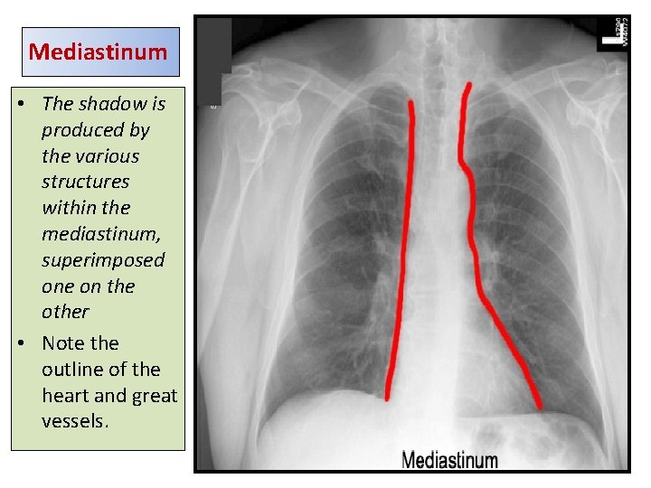 Mediastinum • The shadow is produced by the various structures within the mediastinum, superimposed