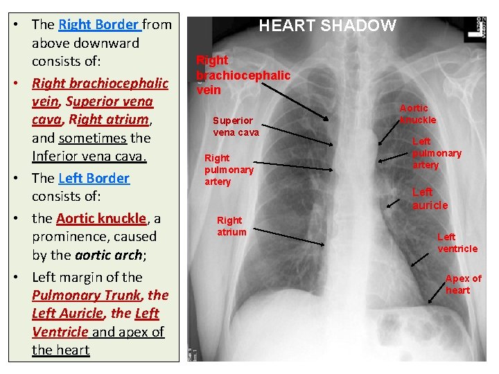  • The Right Border from above downward consists of: • Right brachiocephalic vein,