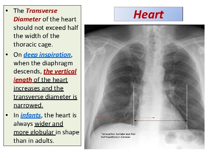 • The Transverse Diameter of the heart should not exceed half the width