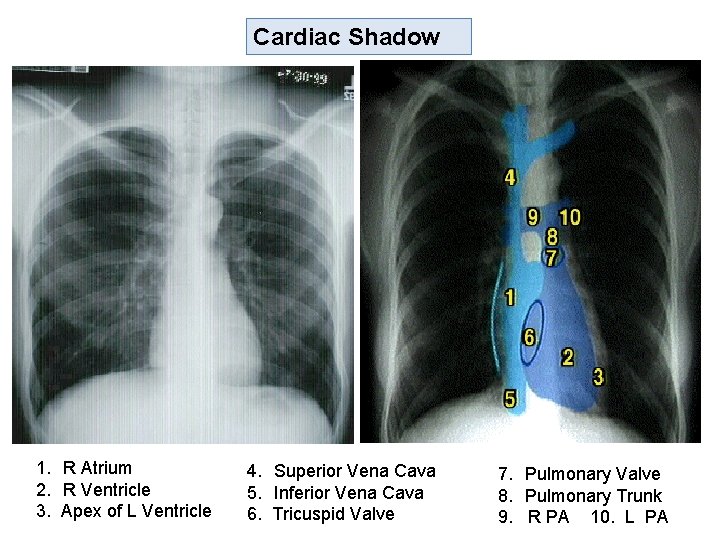 Cardiac Shadow 1. R Atrium 2. R Ventricle 3. Apex of L Ventricle 4.