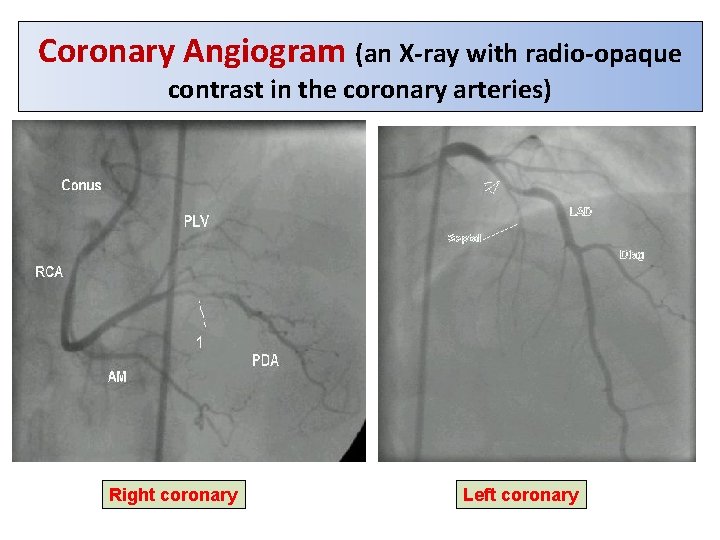 Coronary Angiogram (an X-ray with radio-opaque contrast in the coronary arteries) Right coronary Left