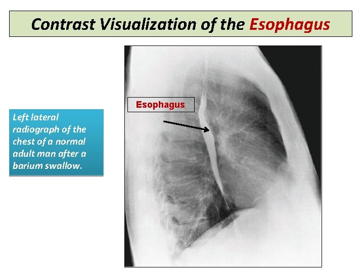 Contrast Visualization of the Esophagus Left lateral radiograph of the chest of a normal