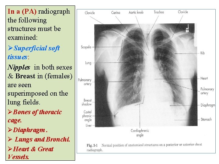 In a (PA) radiograph the following structures must be examined: ØSuperficial soft tissues: Nipples