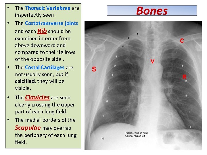  • The Thoracic Vertebrae are imperfectly seen. • The Costotransverse joints and each