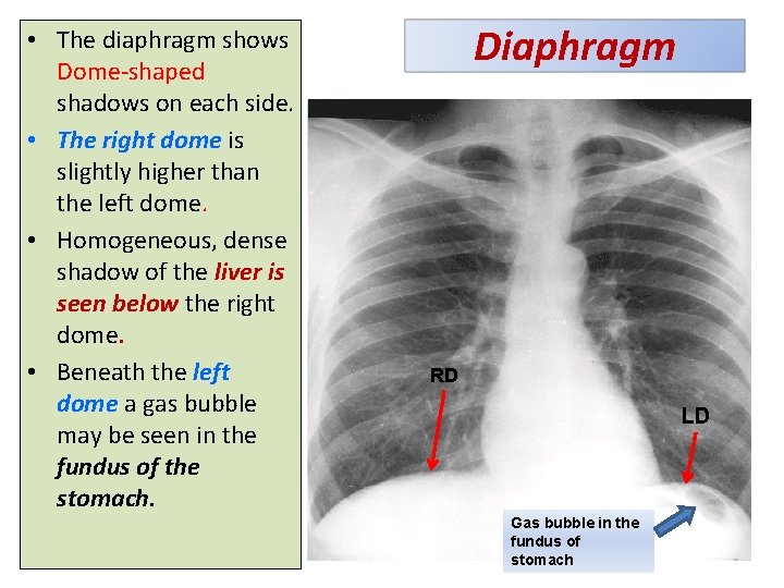  • The diaphragm shows Dome-shaped shadows on each side. • The right dome