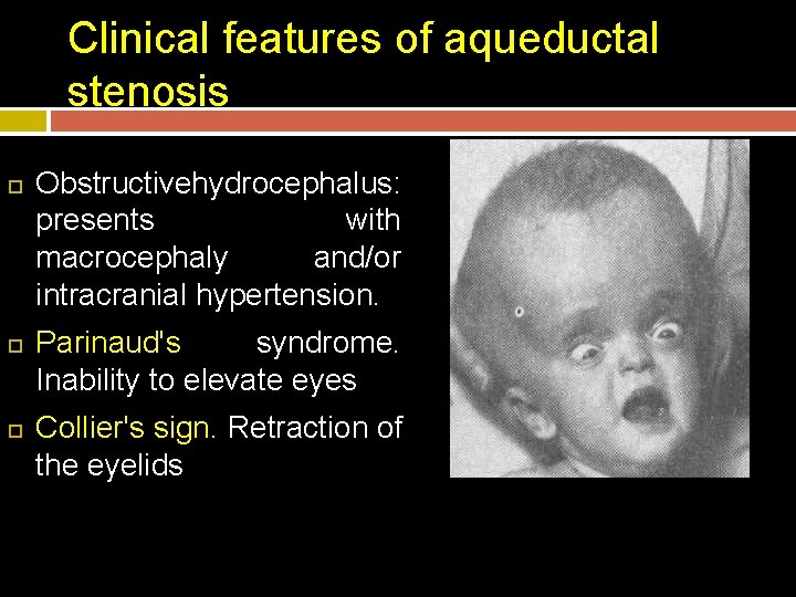Clinical features of aqueductal stenosis Obstructivehydrocephalus: presents with macrocephaly and/or intracranial hypertension. Parinaud's syndrome.