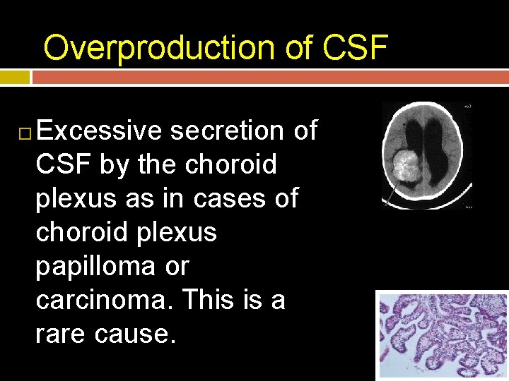 Overproduction of CSF Excessive secretion of CSF by the choroid plexus as in cases