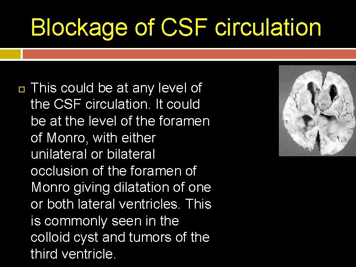 Blockage of CSF circulation This could be at any level of the CSF circulation.