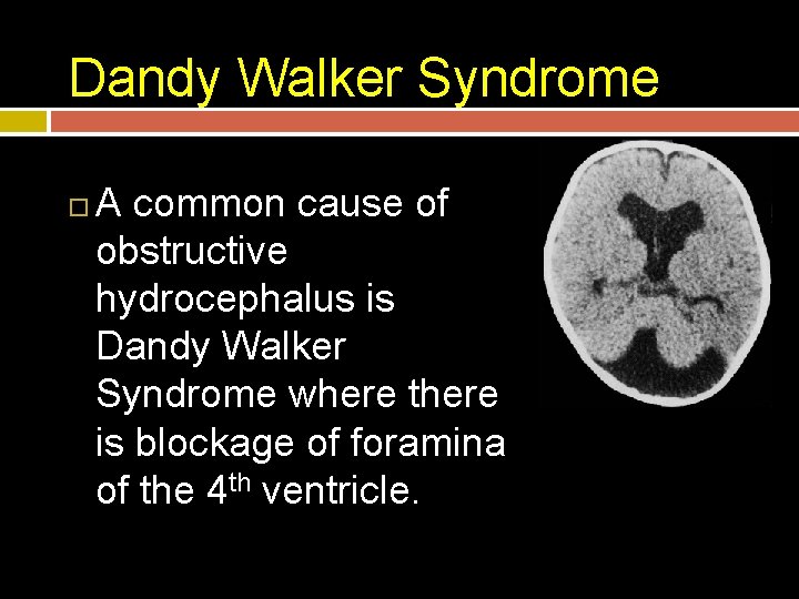 Dandy Walker Syndrome A common cause of obstructive hydrocephalus is Dandy Walker Syndrome where