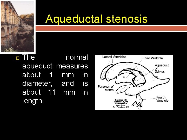 Aqueductal stenosis The normal aqueduct measures about 1 mm in diameter, and is about