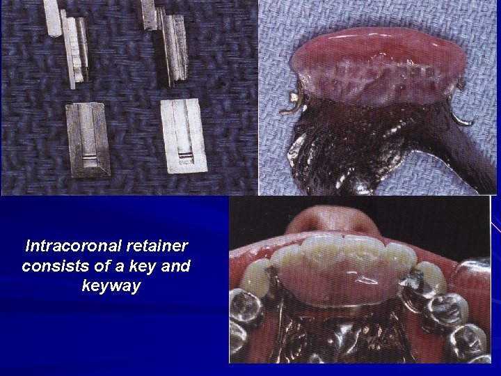 Intracoronal retainer consists of a key and keyway Intracoronal retainer consists of a key and keyway