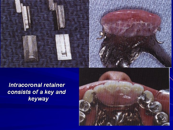 Intracoronal retainer consists of a key and keyway 