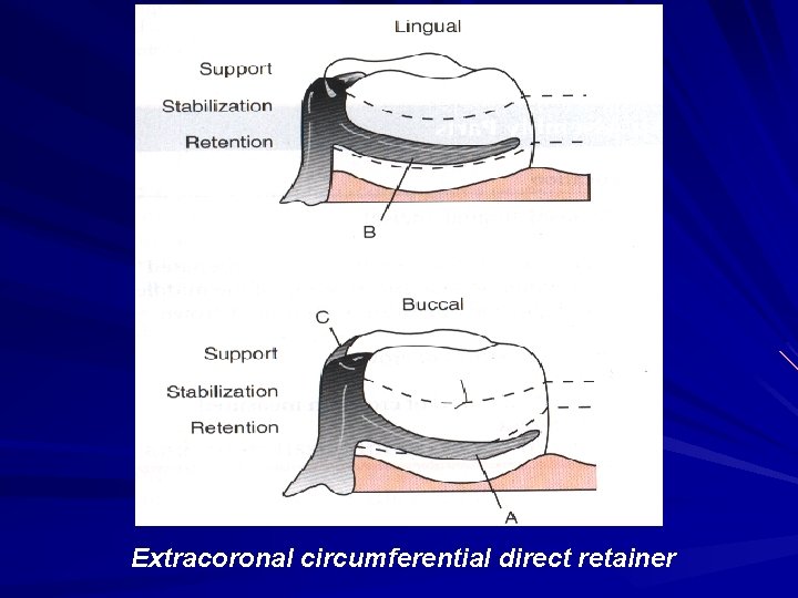 Extracoronal circumferential direct retainer 