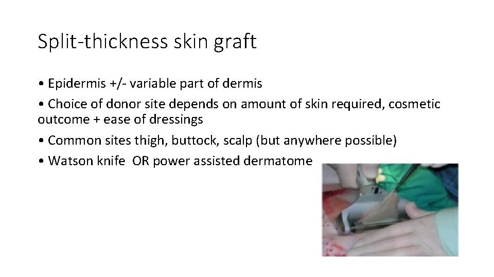 Split-thickness skin graft • Epidermis +/- variable part of dermis • Choice of donor