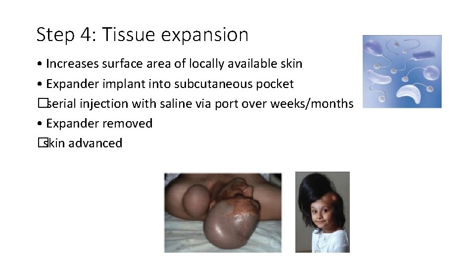 Step 4: Tissue expansion • Increases surface area of locally available skin • Expander