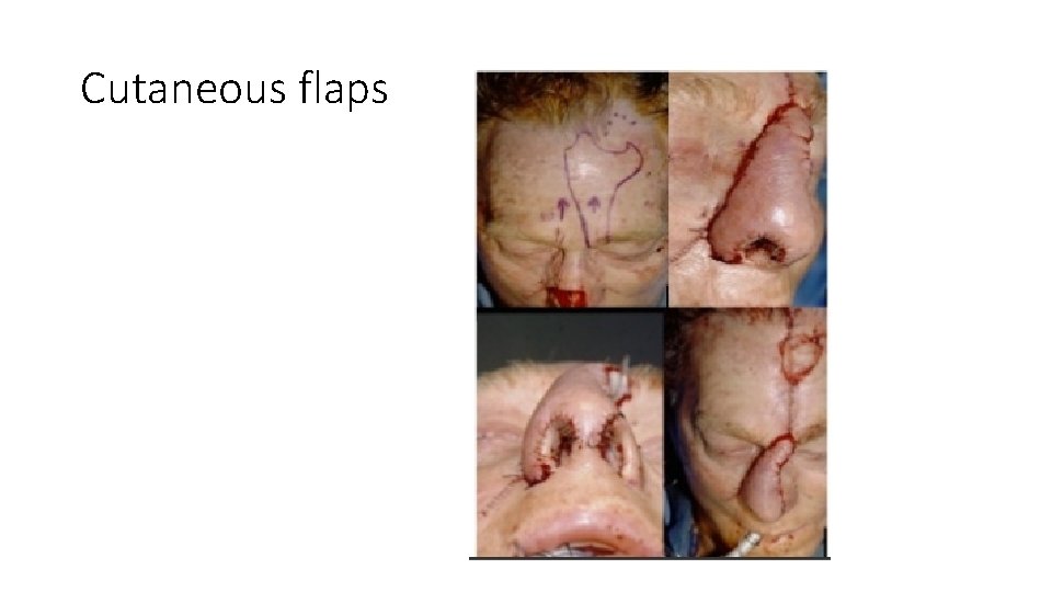 Cutaneous flaps 