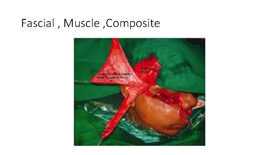 Fascial , Muscle , Composite 
