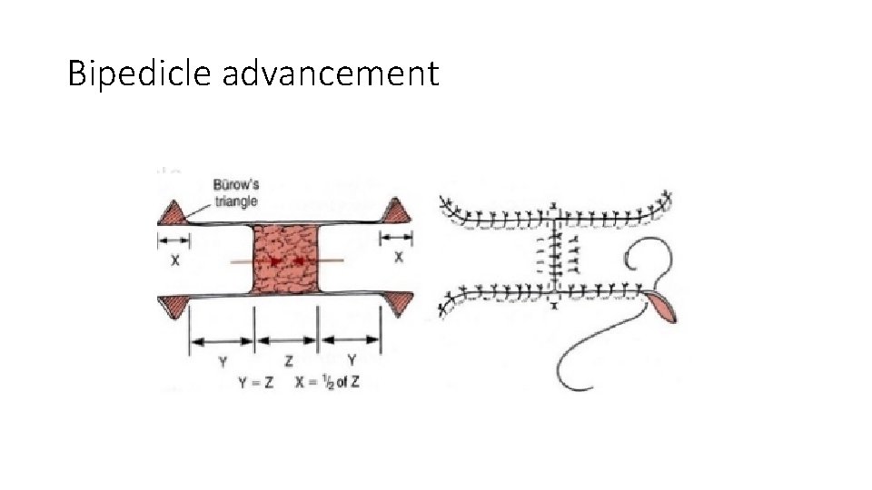 Bipedicle advancement 