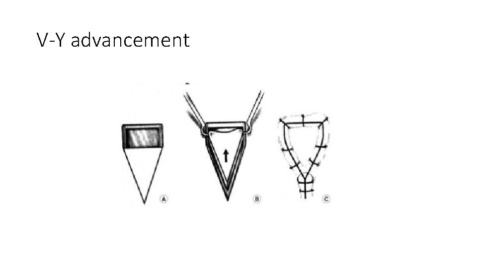 V-Y advancement 