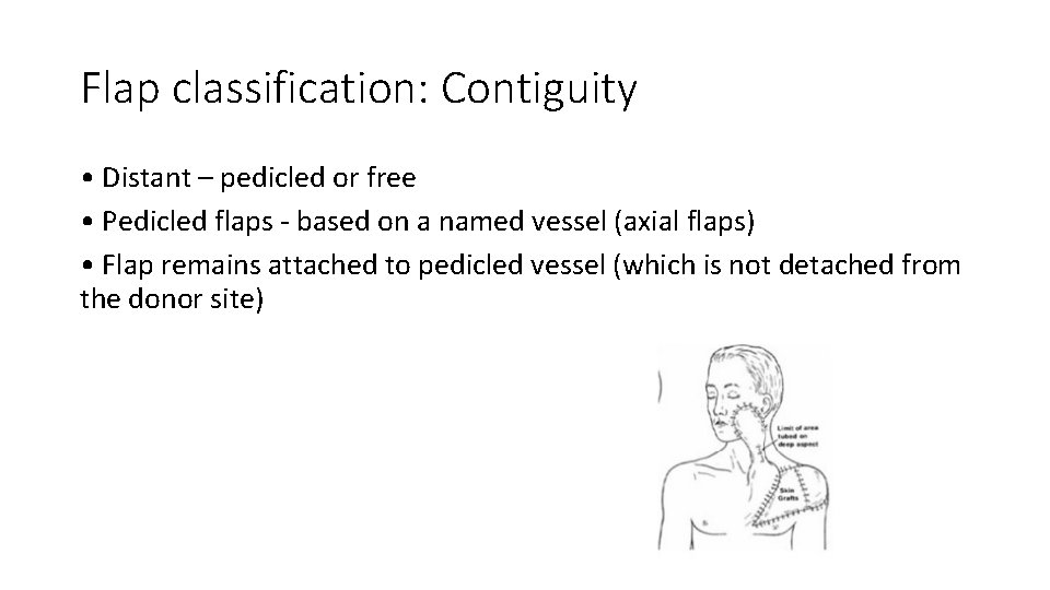 Flap classification: Contiguity • Distant – pedicled or free • Pedicled flaps - based