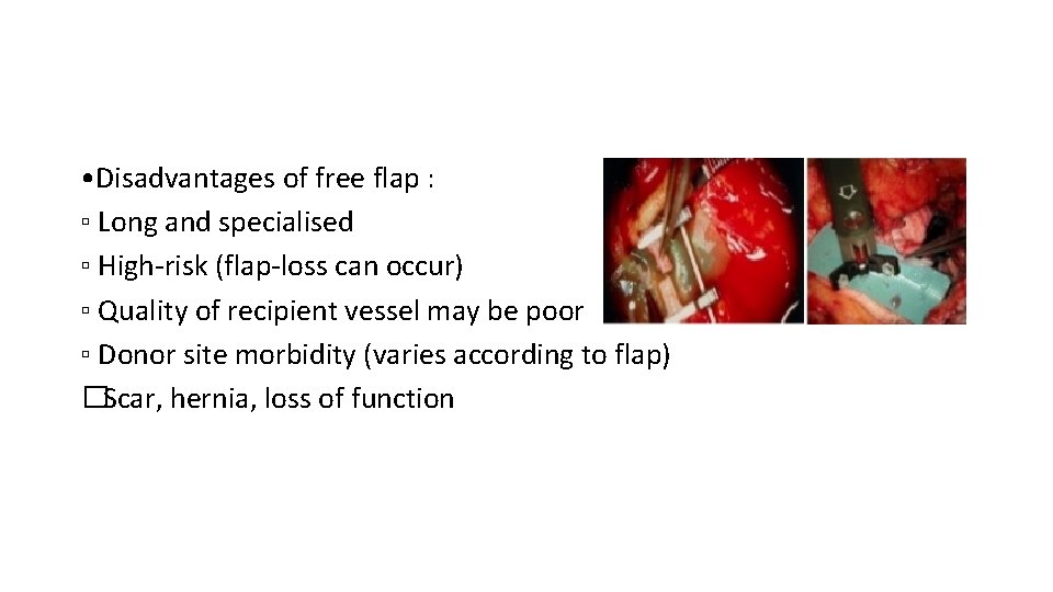 • Disadvantages of free flap : ▫ Long and specialised ▫ High-risk (flap-loss