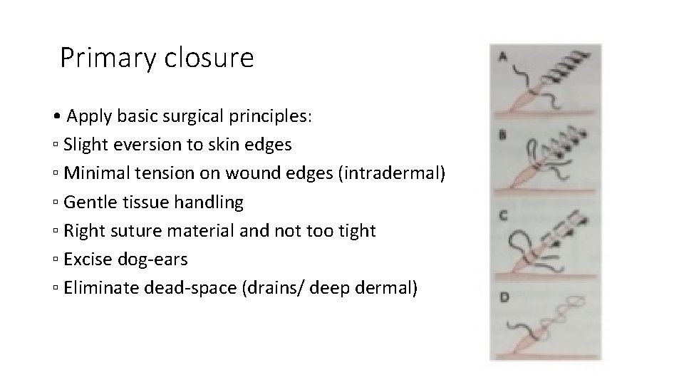 Primary closure • Apply basic surgical principles: ▫ Slight eversion to skin edges ▫