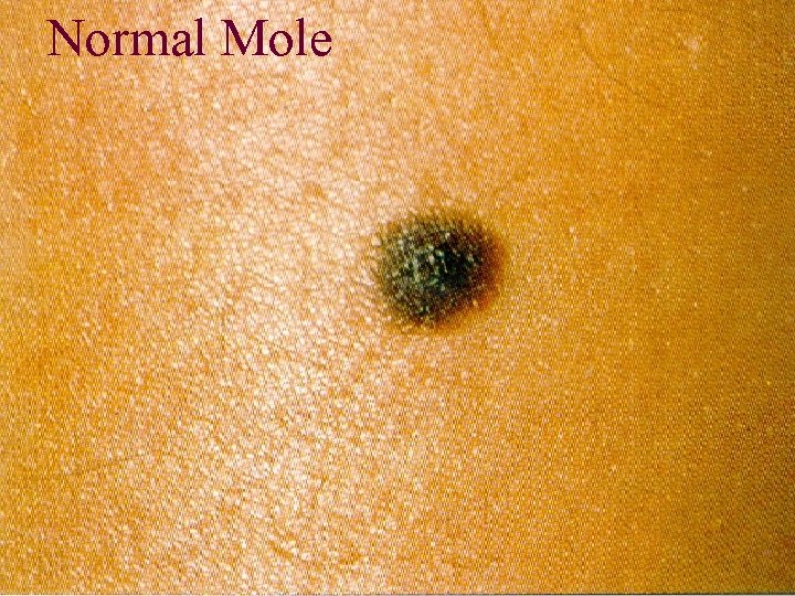 Normal Mole 